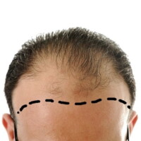 Injerto de pelo implante capilar