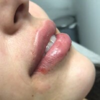 Aumento de labios acido hialuronico