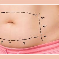 Abdominoplastia abdominoplastia