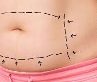 Abdominoplastia abdominoplastia