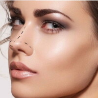 Rinoplastia rinoplastia